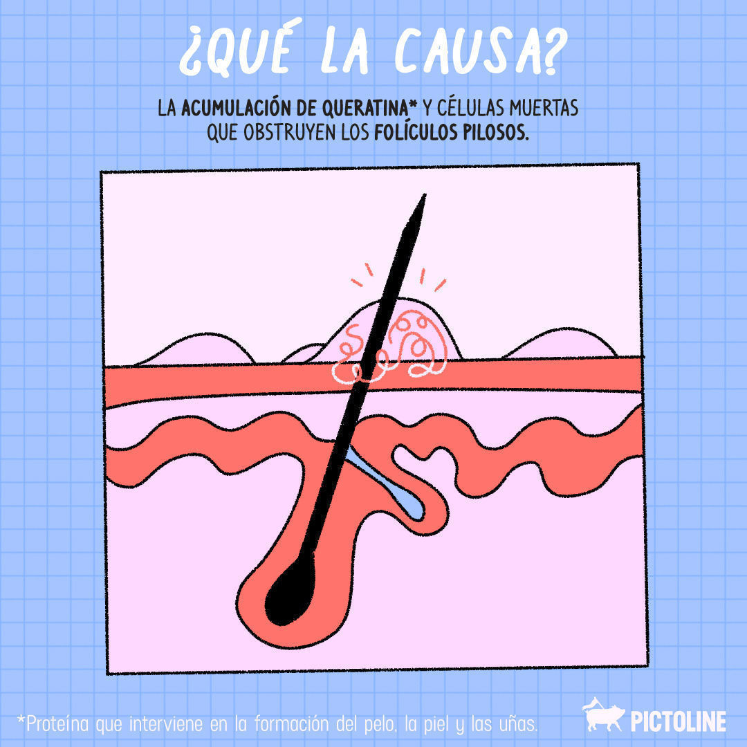 ¿Te han dicho que tienes piel de gallina? 🫠 Se llama #QueratosisPilaris, pero tranqui ✨, es más común de lo que crees ☝️⁣ ⁣ #CuidadoDeLaPiel #TratamientoDeLaPiel #SkinCare #Dermatología #RutinaDeCuidado #Pictoline